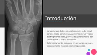 Where Is R Colles fractura de colles, tratamiento y r .pptx