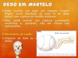  Pode ocorrer um dedo em martelo (mallet
finger) como resultado de uma Fx do lábio
dorsal com ruptura do tendão extensor.

 Mas, pode ocorrer por ruptura puramente
tendinosa e, portanto, não ser visível nas
radiografias.
 Mecanismo de Lesão:
 Impacto de bola ou objeto contra a falange
distal.

 