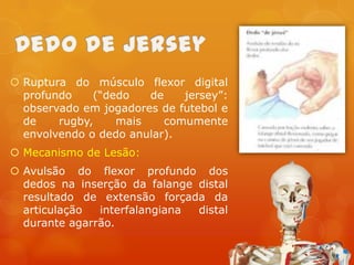  Ruptura do músculo flexor digital
profundo
(“dedo
de
jersey”:
observado em jogadores de futebol e
de
rugby,
mais
comumente
envolvendo o dedo anular).
 Mecanismo de Lesão:
 Avulsão do flexor profundo dos
dedos na inserção da falange distal
resultado de extensão forçada da
articulação
interfalangiana
distal
durante agarrão.

 