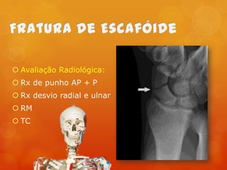  Avaliação Radiológica:
 Rx de punho AP + P
 Rx desvio radial e ulnar

 RM
 TC

 
