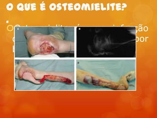 Osteomielite é uma infecção
dos
ossos
causada
por
bactérias ou outros germes

 