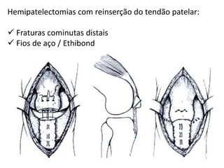 Hemipatelectomias com reinserção do tendão patelar:
 Fraturas cominutas distais
 Fios de aço / Ethibond
 