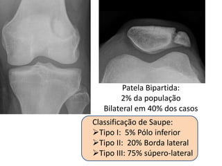 Patela Bipartida:
2% da população
Bilateral em 40% dos casos
Classificação de Saupe:
Tipo I: 5% Pólo inferior
Tipo II: 20% Borda lateral
Tipo III: 75% súpero-lateral
 