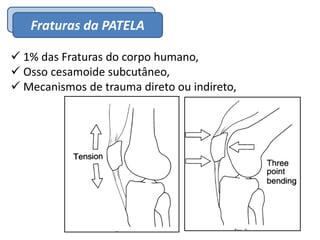EpidemiologiaFraturas da PATELA
 1% das Fraturas do corpo humano,
 Osso cesamoide subcutâneo,
 Mecanismos de trauma direto ou indireto,
 