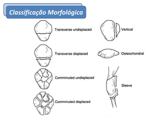 EpidemiologiaClassificação Morfológica
 