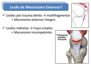 EpidemiologiaLesão de Mecanismo Extensor?
 Lesões por trauma direto → multifragmentar
= Mecanismo extensor íntegro.
 Lesões indiretas → traço simples
= Mecanismo incompetente.
 