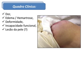 EpidemiologiaQuadro Clínico:
 Dor,
 Edema / Hemartrose,
 Deformidade,
 Incapacidade funcional,
 Lesão da pele (?)
 