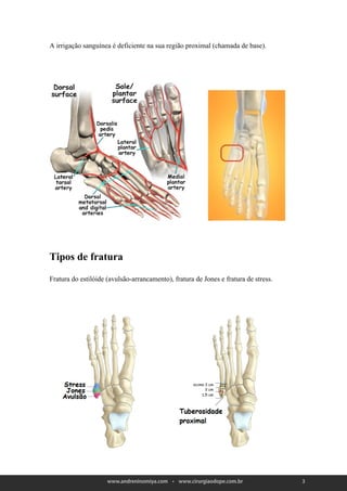 A irrigação sanguínea é deficiente na sua região proximal (chamada de base).




Tipos de fratura

Fratura do estilóide (avulsão-arrancamento), fratura de Jones e fratura de stress.




                                                                                     3
 