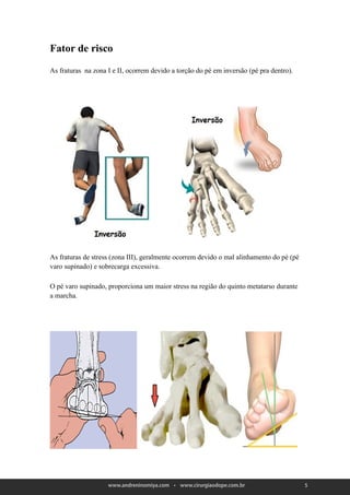 Fator de risco

As fraturas na zona I e II, ocorrem devido a torção do pé em inversão (pé pra dentro).




As fraturas de stress (zona III), geralmente ocorrem devido o mal alinhamento do pé (pé
varo supinado) e sobrecarga excessiva.

O pé varo supinado, proporciona um maior stress na região do quinto metatarso durante
a marcha.




                                                                                          5
 