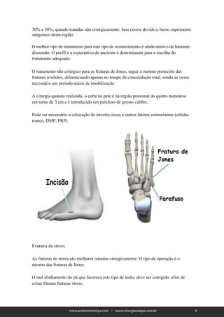 30% a 50%, quando tratadas não cirurgicamente. Isso ocorre devido o baixo suprimento
sanguíneo desta região.

O melhor tipo de tratamento para este tipo de acometimento é ainda motivo de bastante
discussão. O perfil e a expectativa do paciente é determinante para a escolha do
tratamento adequado.

O tratamento não cirúrgico para as fraturas de Jones, segue o mesmo protocolo das
fraturas avulsões, diferenciando apenas no tempo de consolidação total, sendo as vezes
necessário um período maior de imobilização.

A cirurgia quando realizada, o corte na pele é na região proximal do quinto metatarso
em torno de 3 cm e é introduzido um parafuso de grosso calibre.

Pode ser necessário a colocação de enxerto ósseo e outros fatores estimulantes (células
tronco, DMP, PRP).




Fratura de stress

As fraturas de stress são melhores tratadas cirurgicamente. O tipo de operação é o
mesmo das fraturas de Jones.

O mal alinhamento do pé que favorece este tipo de lesão, deve ser corrigido, afim de
evitar futuras fraturas stress.




                                                                                          8
 