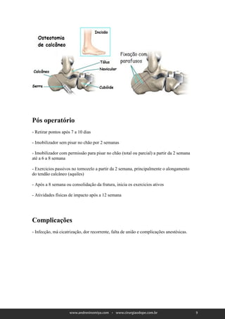 Pós operatório
- Retirar pontos após 7 a 10 dias

- Imobilizador sem pisar no chão por 2 semanas

- Imobilizador com permissão para pisar no chão (total ou parcial) a partir da 2 semana
até a 6 a 8 semana

- Exercicios passivos no tornozelo a partir da 2 semana, principalmente o alongamento
do tendão calcâneo (aquiles)

- Após a 8 semana ou consolidação da fratura, inicia os exercicios ativos

- Atividades físicas de impacto após a 12 semana




Complicações
- Infecção, má cicatrização, dor recorrente, falta de união e complicações anestésicas.




                                                                                          9
 