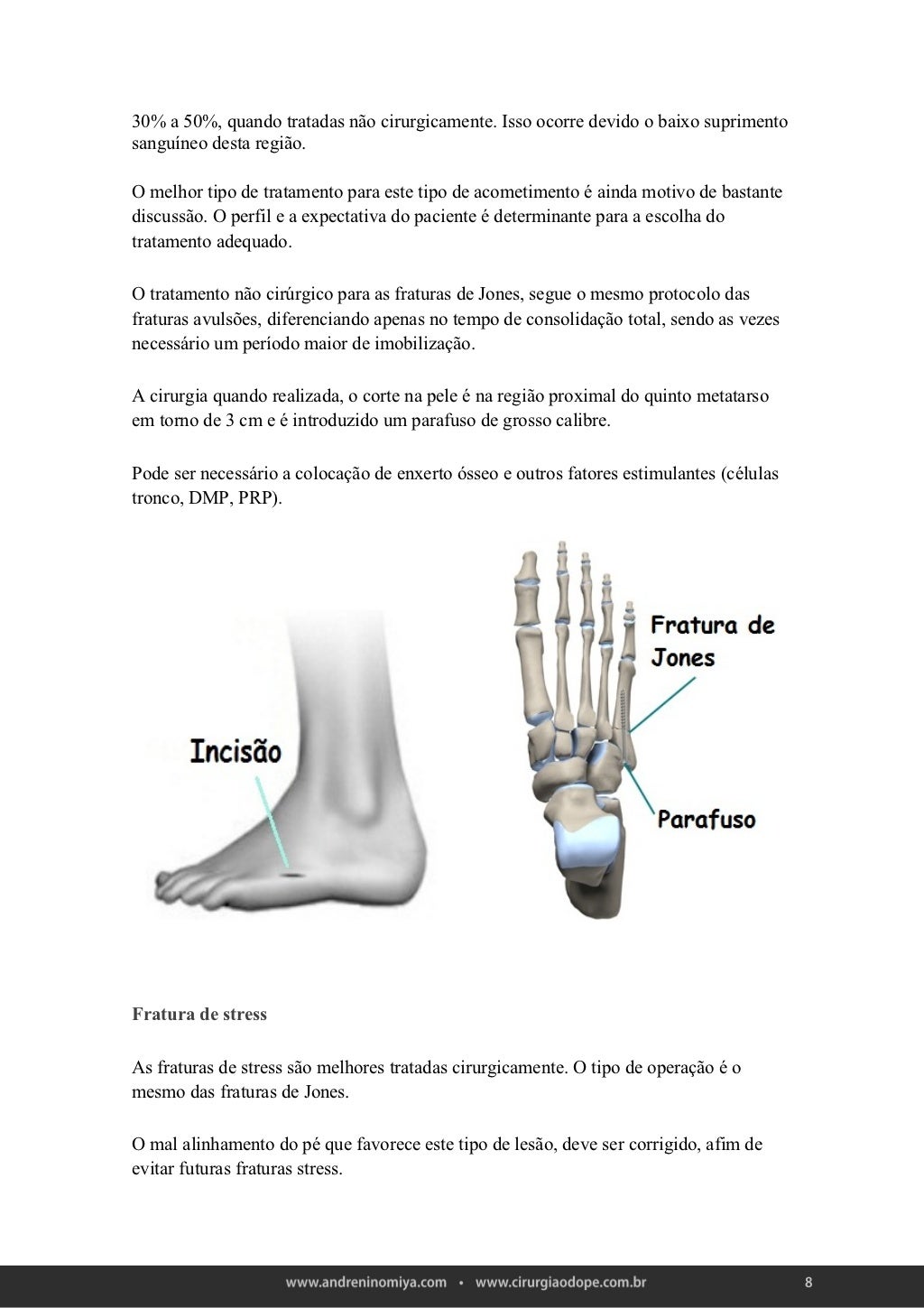 Fratura do quinto metatarso