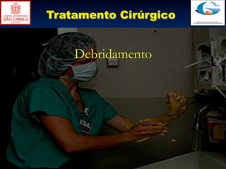 Tratamento Cirúrgico


    Debridamento
 