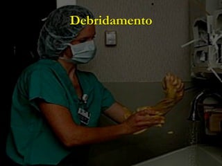 Debridamento
 