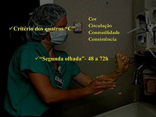 Cor
                            Circulação
Critério dos quatros “C”
                            Contratilidade
                            Consistência


         “Segunda olhada”- 48 a 72h
 