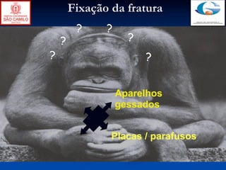 Fixação da fratura
         ?     ?
    ?                ?
?                        ?


                   Aparelhos
                   gessados


                Placas / parafusos
 
