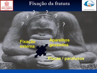 Fixação da fratura
         ?     ?
    ?                ?
?                        ?


Fixação            Aparelhos
externa            gessados


                Placas / parafusos
 