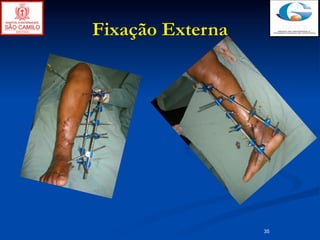 Fixação Externa




                  35
 