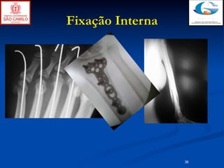 Fixação Interna




                  36
 