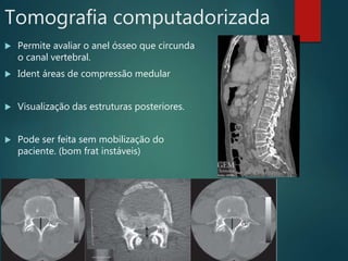 Tomografia computadorizada
 Permite avaliar o anel ósseo que circunda
o canal vertebral.
 Ident áreas de compressão medular
 Visualização das estruturas posteriores.
 Pode ser feita sem mobilização do
paciente. (bom frat instáveis)
 