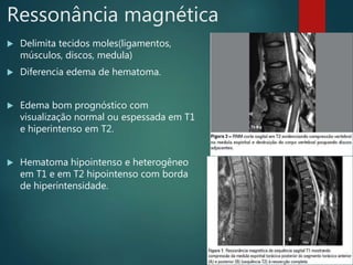 Ressonância magnética
 Delimita tecidos moles(ligamentos,
músculos, discos, medula)
 Diferencia edema de hematoma.
 Edema bom prognóstico com
visualização normal ou espessada em T1
e hiperintenso em T2.
 Hematoma hipointenso e heterogêneo
em T1 e em T2 hipointenso com borda
de hiperintensidade.
 