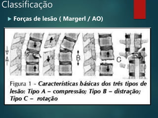 Classificação
 Forças de lesão ( Margerl / AO)
 