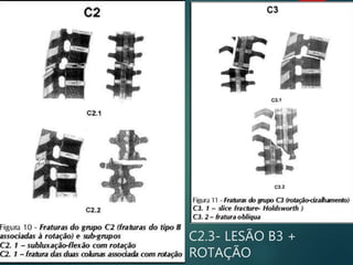 C2.3- LESÃO B3 +
ROTAÇÃO
 