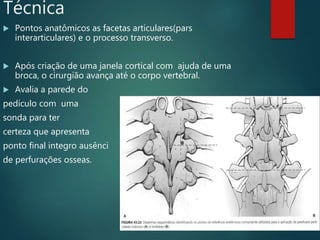 Técnica
 Pontos anatômicos as facetas articulares(pars
interarticulares) e o processo transverso.
 Após criação de uma janela cortical com ajuda de uma
broca, o cirurgião avança até o corpo vertebral.
 Avalia a parede do
pedículo com uma
sonda para ter
certeza que apresenta
ponto final integro ausênci
de perfurações osseas.
 