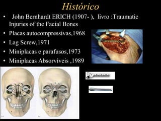 Histórico
• John Bernhardt ERICH (1907- ), livro :Traumatic
Injuries of the Facial Bones
• Placas autocompressivas,1968
• Lag Screw,1971
• Miniplacas e parafusos,1973
• Miniplacas Absorvíveis ,1989
 