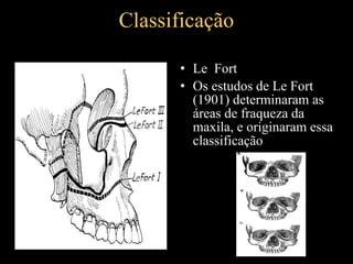 Classificação
• Le Fort
• Os estudos de Le Fort
(1901) determinaram as
áreas de fraqueza da
maxila, e originaram essa
classificação
 
