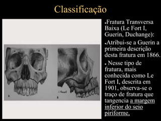 Classificação
●Fratura Transversa
Baixa (Le Fort I,
Guerin, Duchange):
●Atribui-se a Guerin a
primeira descrição
desta fratura em 1866.
● Nesse tipo de
fratura, mais
conhecida como Le
Fort I, descrita em
1901, observa-se o
traço de fratura que
tangencia a margem
inferior do seio
piriforme,
 