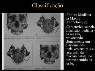 Classificação
●Fratura Mediana
da Maxila
(Lannelongue):
●Caracteriza-se pela
disjunção mediana
da maxila,
provocando
clinicamente um
diastema dos
incisivos centrais e
laceração da
mucosa palatal no
mesmo sentido da
lesão.
 