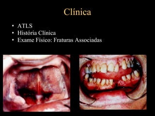 Clínica
• ATLS
• História Clínica
• Exame Físico: Fraturas Associadas
 