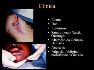 Clínica
• Edema
• Dor
• Equimose
• Sangramento Nasal,
Otorragia
• Alteração da Oclusão
Dentária
• Anestesia
• Palpação: bidigital –
mobilidade da maxila
 