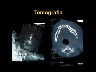 Tomografia
 