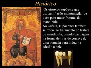 Histórico
• Os etruscos supõe-se que
usavam fiação monomaxilar de
ouro para tratar fraturas da
mandíbula.
Na Grécia, Hipócrates também
se refere ao tratamento de fratura
de mandíbula, usando bandagem
na forma de tiras de couro e de
uma pomada para induzir a
adesão à pele
 