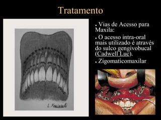 Tratamento
● Vias de Acesso para
Maxila:
● O acesso intra-oral
mais utilizado é através
do sulco gengivobucal
(Cadwell Luc).
● Zigomaticomaxilar
 