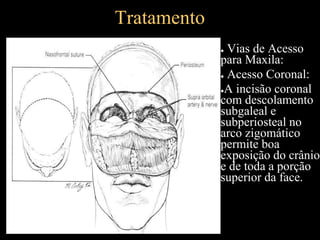Tratamento
● Vias de Acesso
para Maxila:
● Acesso Coronal:
●A incisão coronal
com descolamento
subgaleal e
subperiosteal no
arco zigomático
permite boa
exposição do crânio
e de toda a porção
superior da face.
 