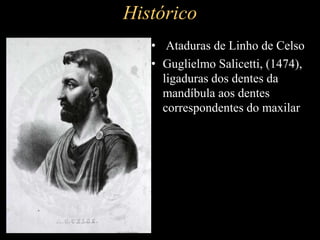 Histórico
• Ataduras de Linho de Celso
• Guglielmo Salicetti, (1474),
ligaduras dos dentes da
mandíbula aos dentes
correspondentes do maxilar
 