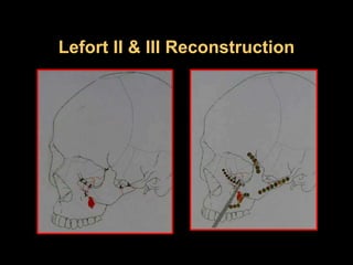 Lefort II & III Reconstruction
 
