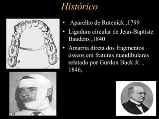 Histórico
• Aparelho de Rutenick ,1799
• Ligadura circular de Jean-Baptiste
Baudens ,1840
• Amarria direta dos fragmentos
ósseos em fraturas mandibulares
relatado por Gurdon Buck Jr. ,
1846,
 