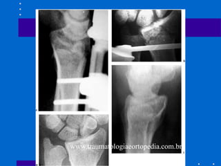 www.traumatologiaeortopedia.com.br
 