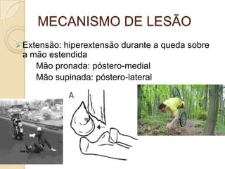 MECANISMO DE LESÃO
 Extensão:hiperextensão durante a queda sobre
 a mão estendida
    Mão pronada: póstero-medial
    Mão supinada: póstero-lateral
 
