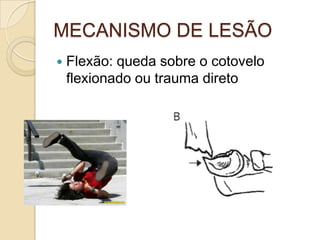 MECANISMO DE LESÃO
   Flexão: queda sobre o cotovelo
    flexionado ou trauma direto
 