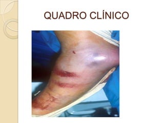 QUADRO CLÍNICO
 