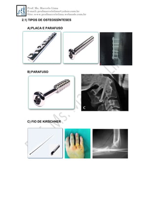 Prof. Ms. Marcelo Lima
E-mail: profmarcelolima@yahoo.com.br
Site: www.profmarcelolima.webnode.com.br
2.1) TIPOS DE OSTEOSSÍNTESES
A) PLACA E PARAFUSO
B) PARAFUSO
C) FIO DE KIRSCHNER
 