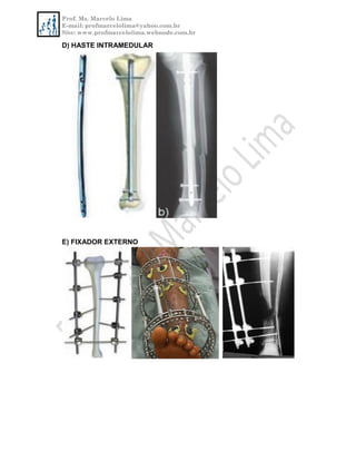 Prof. Ms. Marcelo Lima
E-mail: profmarcelolima@yahoo.com.br
Site: www.profmarcelolima.webnode.com.br
D) HASTE INTRAMEDULAR
E) FIXADOR EXTERNO
 