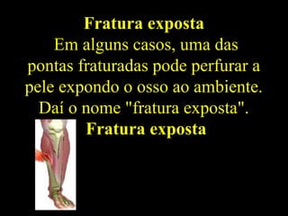 Fratura exposta
Em alguns casos, uma das
pontas fraturadas pode perfurar a
pele expondo o osso ao ambiente.
Daí o nome "fratura exposta".
Fratura exposta
 