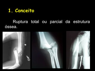 1. Conceito
Ruptura total ou parcial da estrutura
óssea.
 