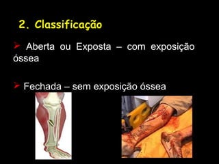 2. Classificação
 Aberta ou Exposta – com exposição
óssea
 Fechada – sem exposição óssea
 